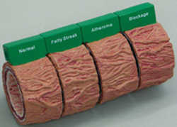 Artery Blockage Models Pharmaceutical and Anatomical Model Gifts